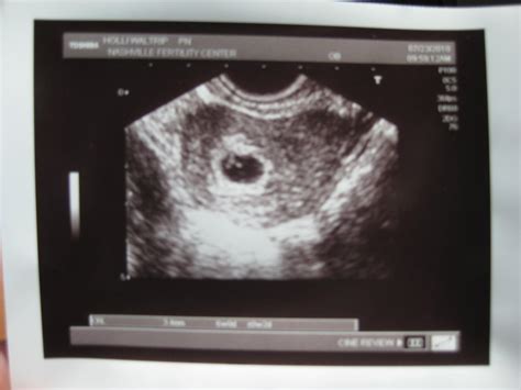 It's a Waltrip Life: First ultrasound- 6 weeks