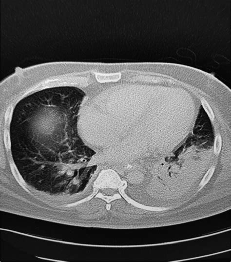 CT scan chest with contrast showed left lower lobe consolidation with... | Download Scientific ...