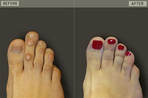 Cosmetic Foot Surgery Before and After | Corrective Foot Surgery New York