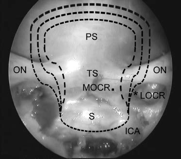 Surgical Removal of Tuberculum Sellae Meningiomas: Endoscopic vs ...