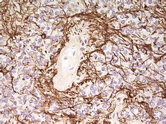 Ependymoma - Libre Pathology