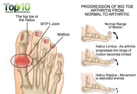 Pin on Joint Pain relief