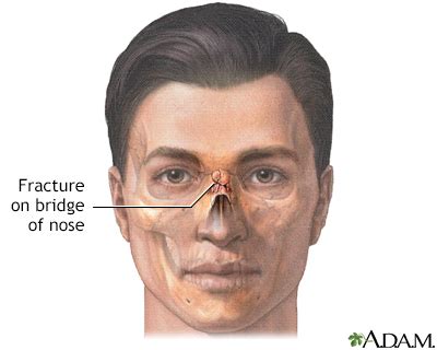 HIE Multimedia - Nose fracture