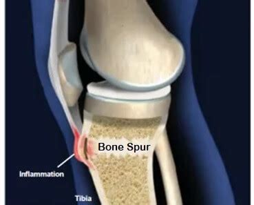 Bone Spurs In Knee: Causes, Symptoms & Treatment Of Knee Osteophytosis