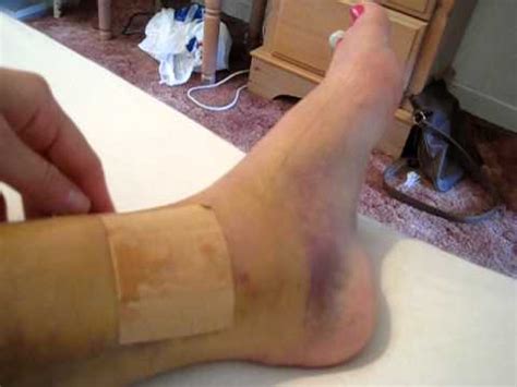 Broken Tibia & Fibula - no cast - Day 9 - YouTube