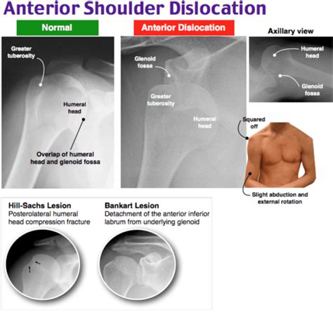 Anterior Shoulder Dislocation