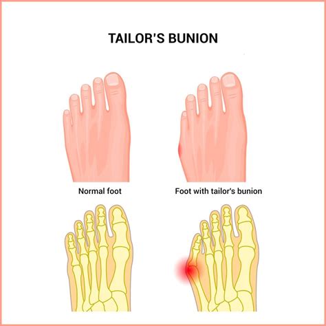 Tailor Bunion Surgery Miami: Expert Care for Foot Pain Relief