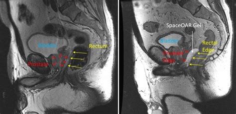 Reducing Side Effects During Radiotherapy for Prostate Cancer – Department of Human Oncology ...