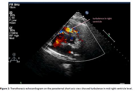 Isolated Double-chambered Right Ventricle - A Rare Congenital Heart ...