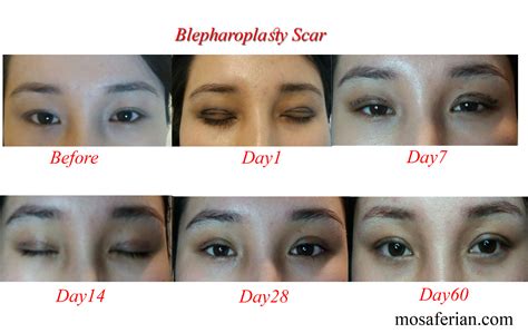 blepharoplasty scars