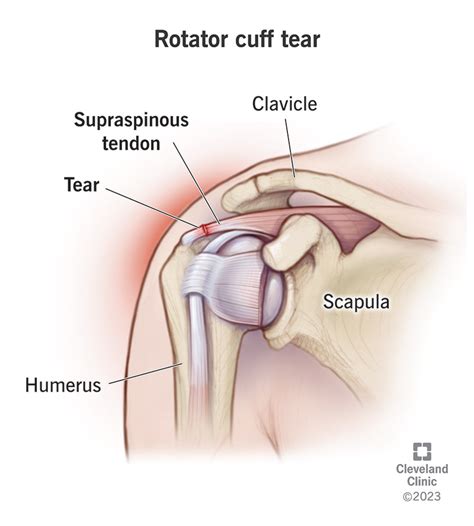 Rotator Cuff Tear Symptoms Treatment 3888 | The Best Porn Website