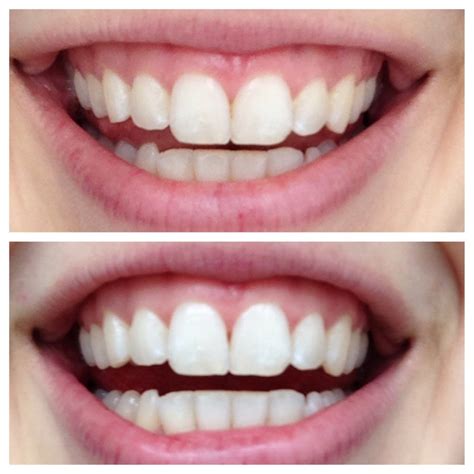 Laurendamarie Teeth Whitening with Activated Charcoal Before and After ...