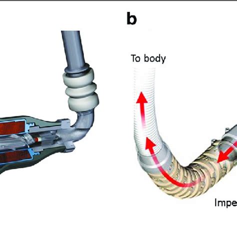 Classification of mechanical circulatory support devices. BiVAD ...