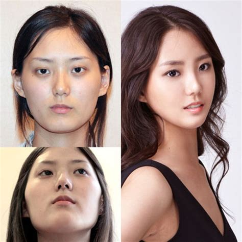 Antes e depois da cirurgia plástica coreana 2 (61 fotos) - MDig