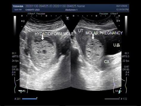 Ultrasound Video showing Hydatidiform Mole, also called Molar Pregnancy ...