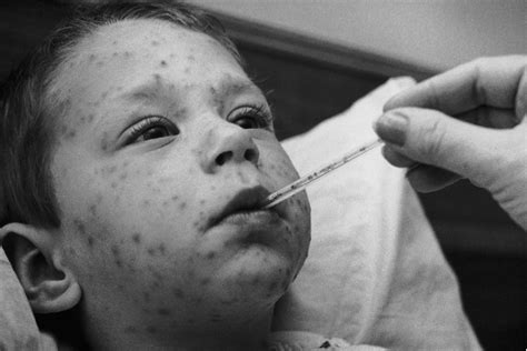 CDC: Chickenpox vaccine has almost wiped out severe illness from the virus