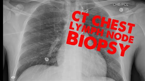 CT Chest Lymph Node Biopsy - YouTube