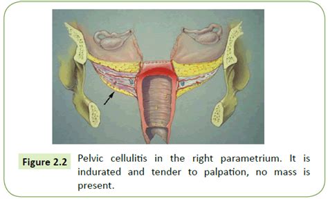 Parametrium