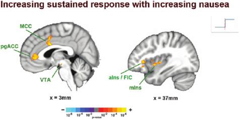 Sustained brain response following nausea rating increase. Increasing... | Download Scientific ...