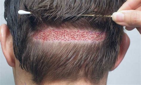 Hair Transplants - Growing Your Hair Back With Modern Procedures