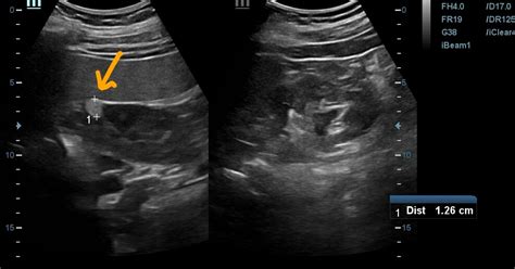 Ultrasound imaging: Angiomyolipoma-of-right-kidney