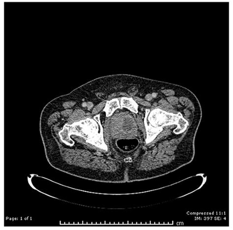 Prostate abscess | Urology News