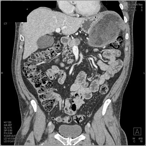 Omental Infarct Simulates a Gastric Mass or Tumor Recurrence - Stomach ...