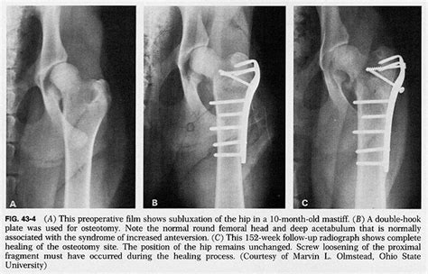 femoral osteotomy...change the angle of the neck so the femur sits better (lower in this case ...