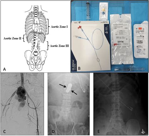 REBOA overview and selected complications. a Anatomic depiction the... | Download Scientific Diagram