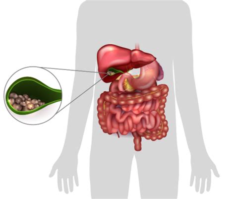 What Are the Symptoms of a Gallbladder Attack | The Surgical Clinic