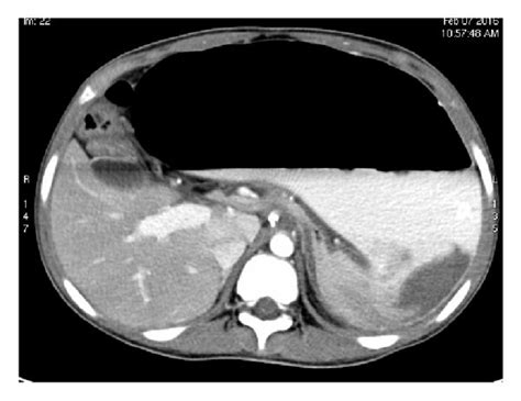 CT scan with oral and intravenous contrast. CT scanogram (a), axial CT... | Download Scientific ...