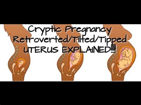 Cryptic Pregnancy--Retroverted/Tilted/Tipped Uterus Explained! - YouTube