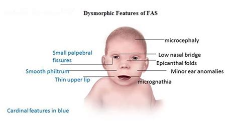 Assessment for Fetal Alcohol Spectrum Disorder