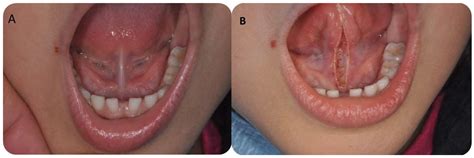 Sublingual Caruncle Swelling