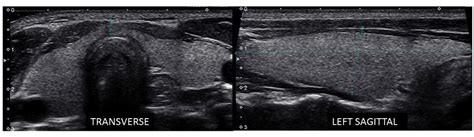 Incidental detection of ectopic thyroid tissue