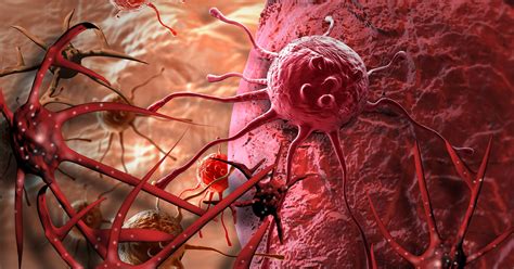 Adrenocortical Carcinoma Cancer | Endocrine Society