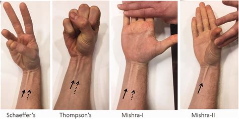 Palmaris Longus Test