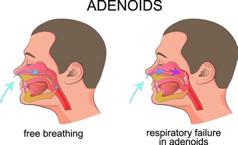 Adenoid Face Before And After