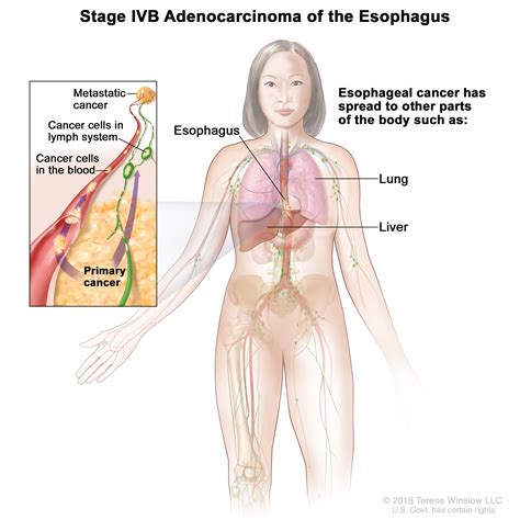 Esophageal Cancer Treatment (PDQ®) - NCI