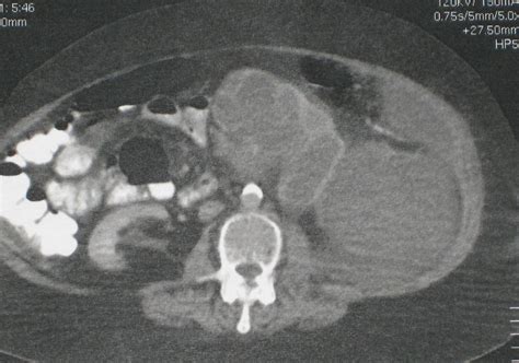 Pyonephrosis left kidney - CT scan - DocCheck