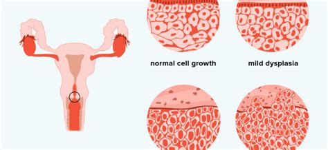 Cervical dysplasia – causes, symptoms, treatment, prevention – Healthy ...