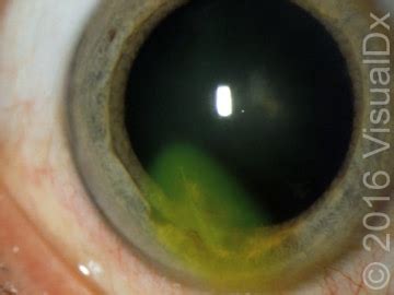 Ocular trauma: Look out for these findings when treating patients’ eye ...