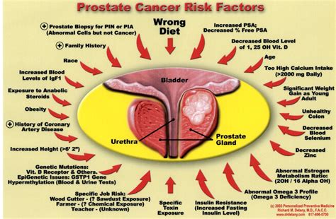 Keeping it Simple (KISBYTO): Prostate Cancer Month