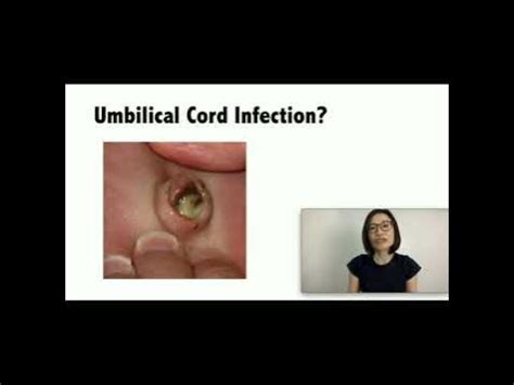 Umbilical cord infections - YouTube