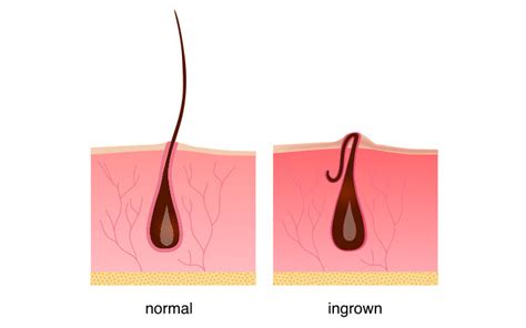 Ingrown Hair: Symptoms, Treatment & Prevention – SkinKraft