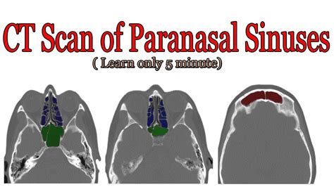 CT scan of paranasal sinuses anatomy - YouTube