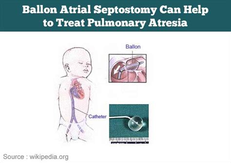 Pulmonary Atresia