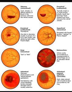 FUNDOSCOPY Eye Health Facts, Eye Retina, Diseases Of The Eye, Medicine ...