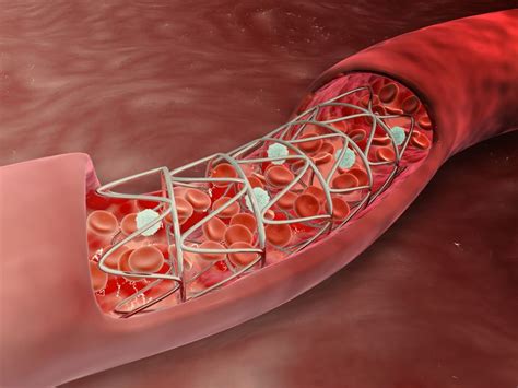 Stent cardiovascular: tipos y riesgos