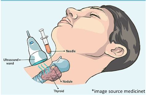 LYMPH NODE BIOPSY – Dr. Gurucharan S Shetty